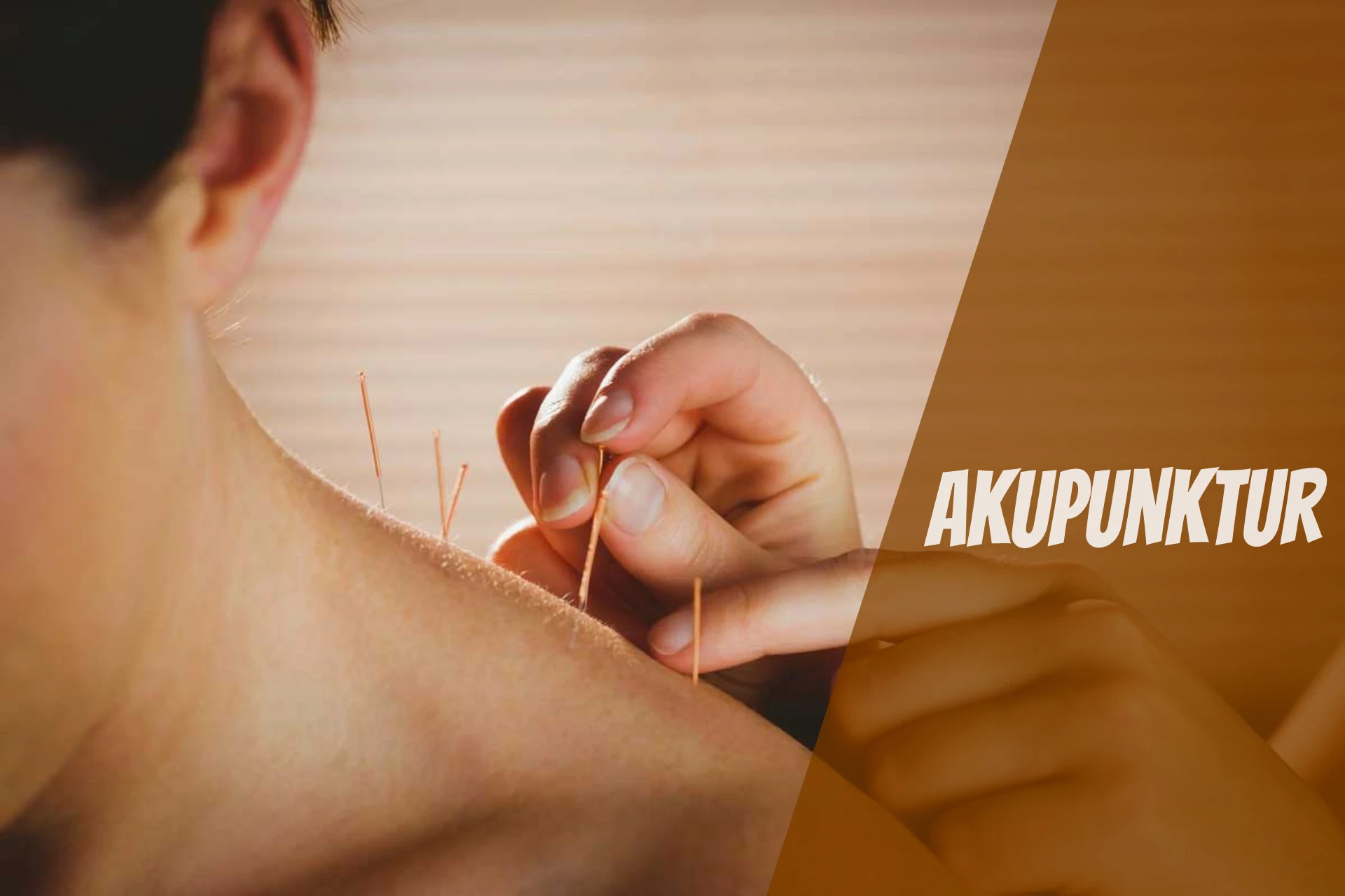 Akupunktur
